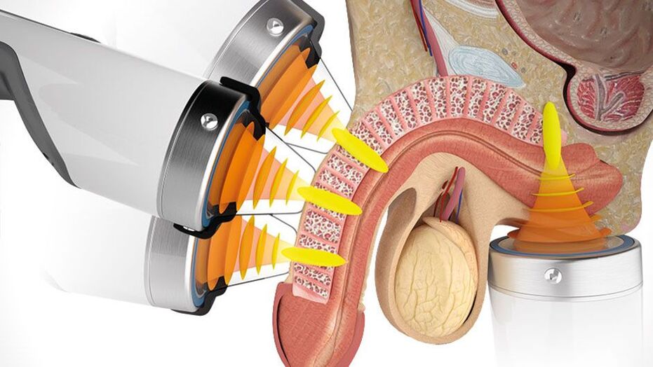 stage of penis enlargement surgery